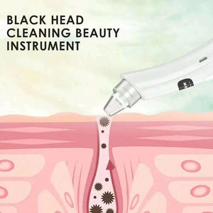 جهاز Blackhead Remover لإزالة الرؤوس السوداء وتنظيف المسام.