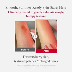 Red Acne Body Peeling Shot | مقشر ميديكيوب الكوري لعلاج حبوب الجسم.