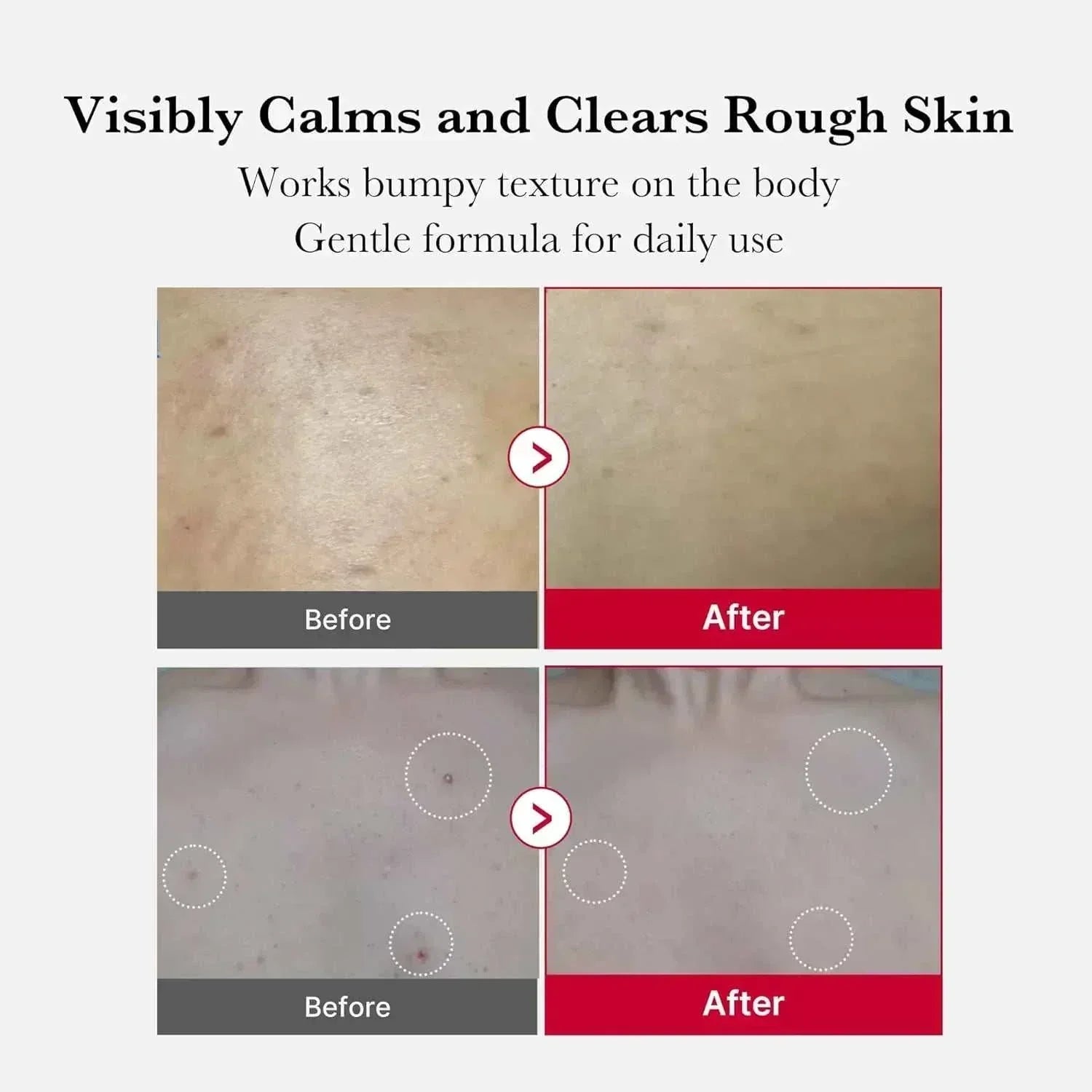 Red Acne Body Peeling Shot | مقشر ميديكيوب الكوري لعلاج حبوب الجسم.
