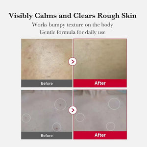Red Acne Body Peeling Shot | مقشر ميديكيوب الكوري لعلاج حبوب الجسم.